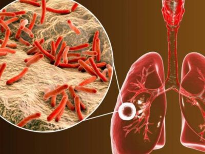 سل هنوز در ایران وجود دارد